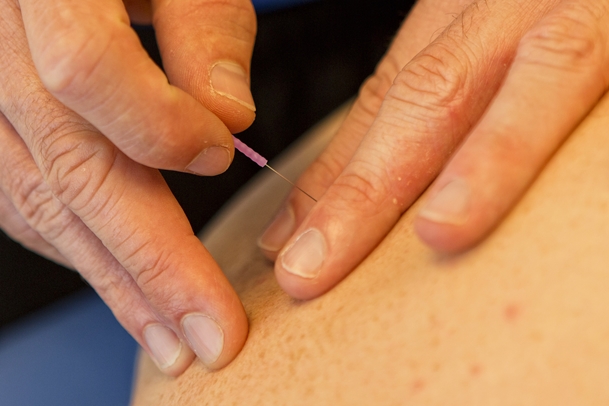 Dry Needling Fysiotherapeut